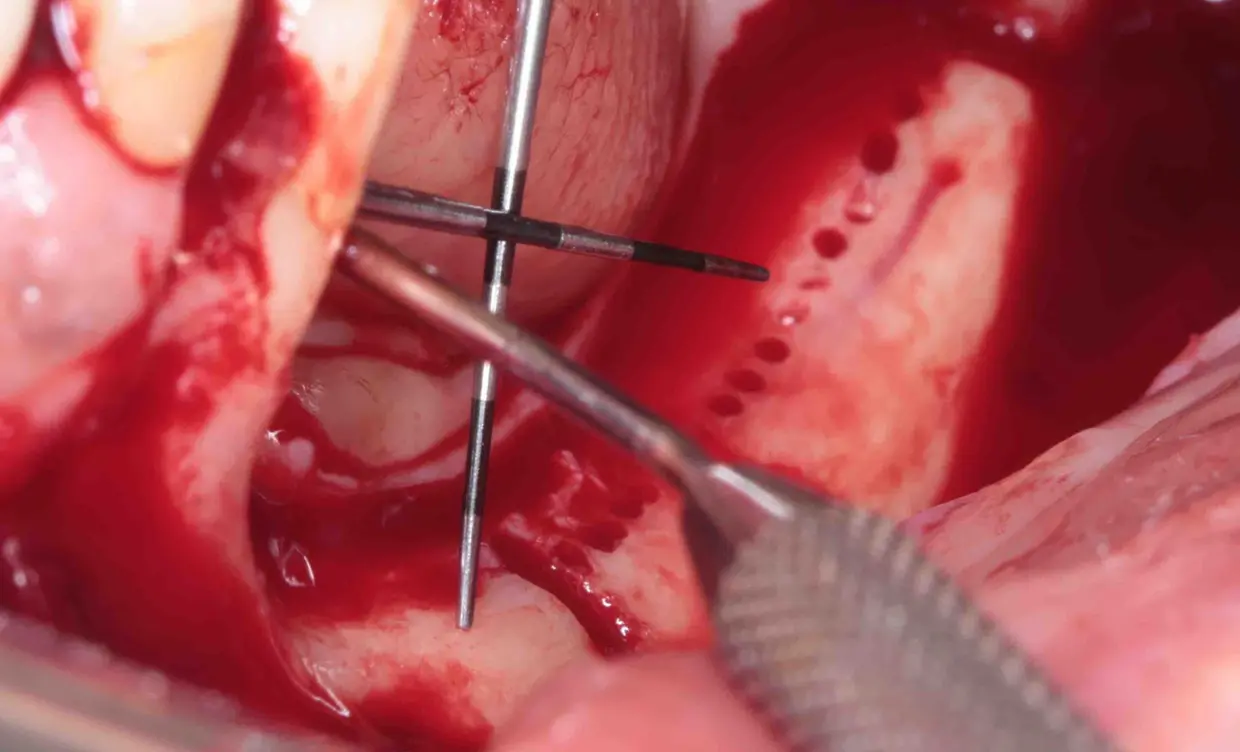 Regenerated bone, probed during surgery