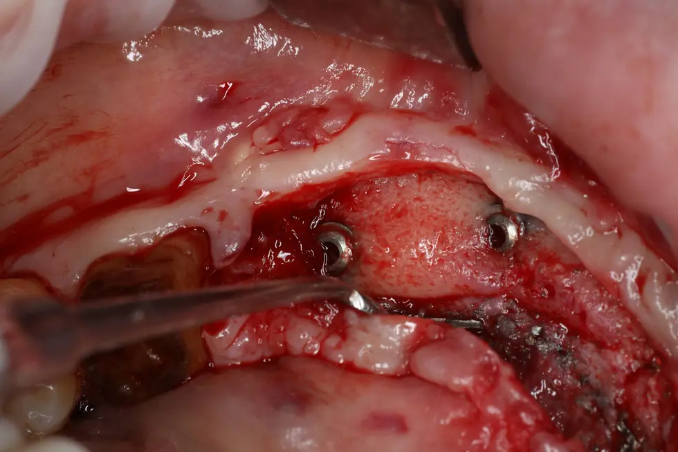 bone course reconstruction hawaii