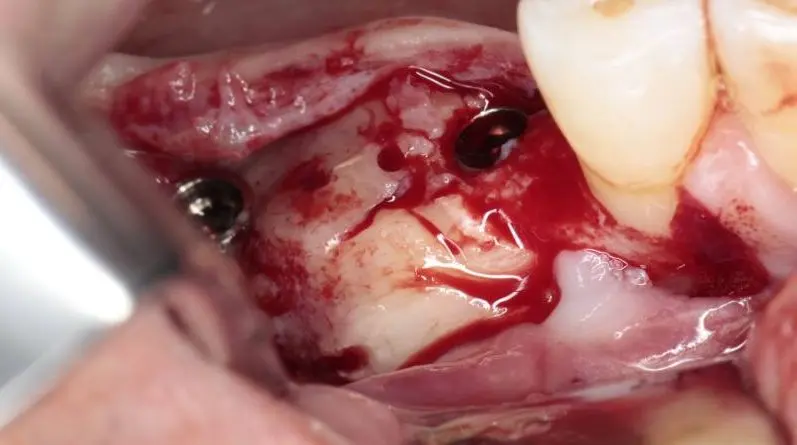 Casos clínicos cirugía oral